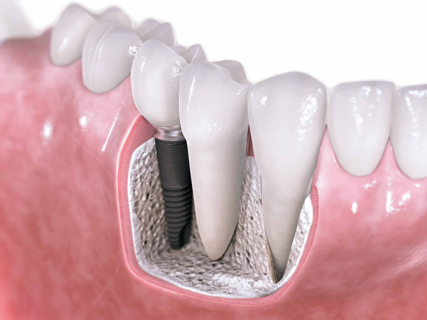 Dental-implants-3D