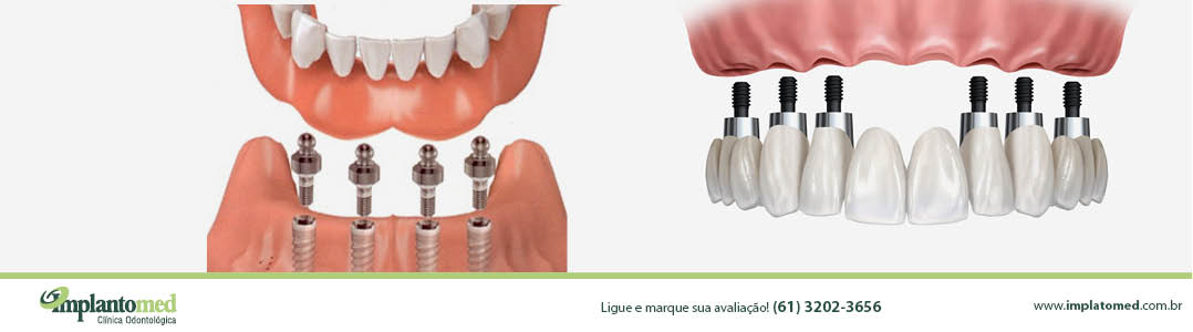 implante_implantes_dentario_dentarios_brasilia_distrito_federal_banners_implantomed_1078x300px15203